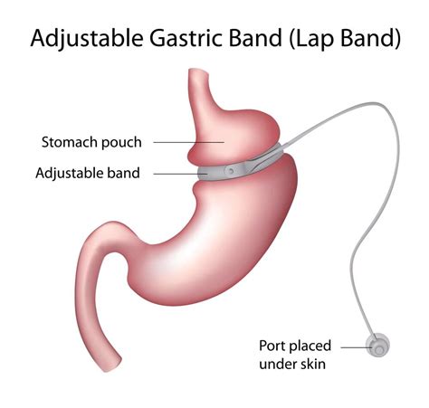 What Is The Difference Between Lap Band Surgery And Gastric Bypass