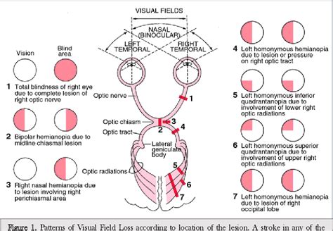 Effects Of Noninvasive Brain Stimulation In Cerebral Stroke Related