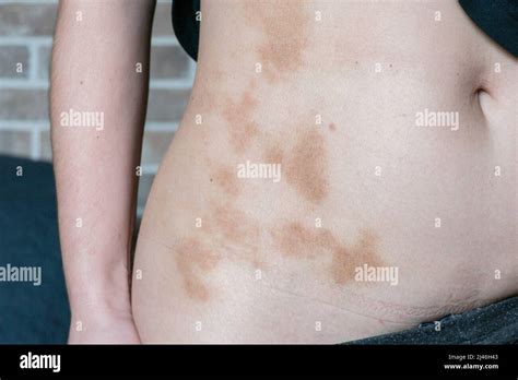 Red Brown Spots On The Skin Of A Woman Near The Abdomen Stock Photo Alamy