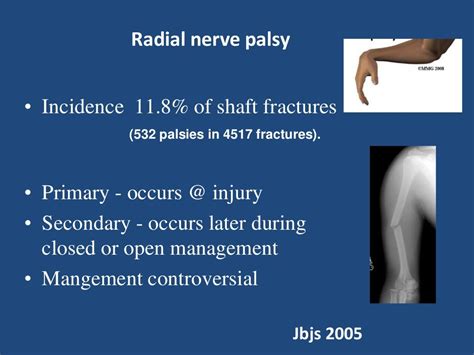 Radial Nerve Palsy