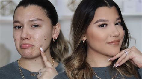 How To Cover Acne I My Flawless Foundation Routine Youtube