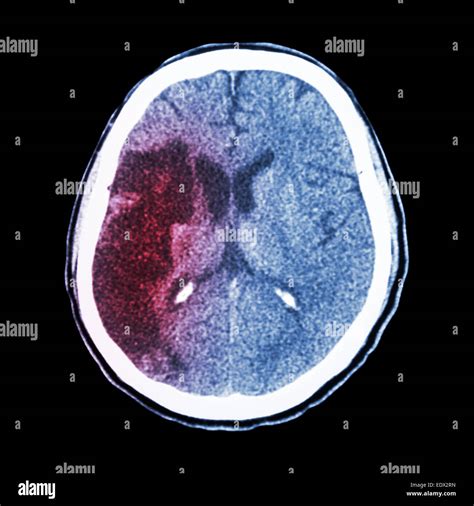 Ct Brain Show Ischemic Stroke Hypodensity At Right Frontal Parietal