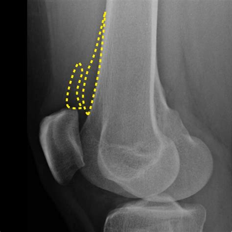 Knee X Rays