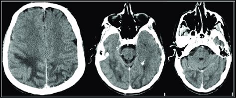 Ct Brain Scan With Contrast On Day 2 Low Attenuation Changes In The