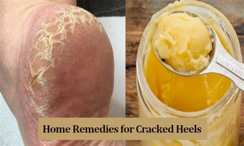 10 Best And Effective Home Remedies For Cracked Heels