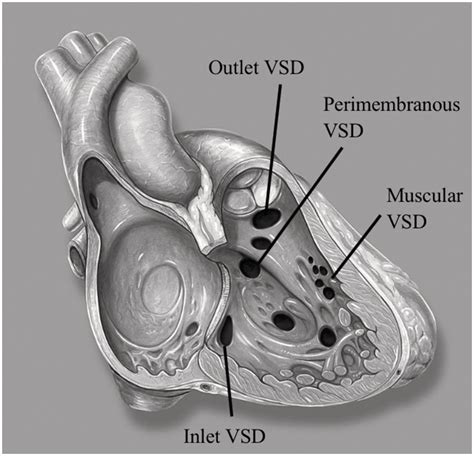 Chapter 62 Ventricular Septal Defects Anesthesia Key