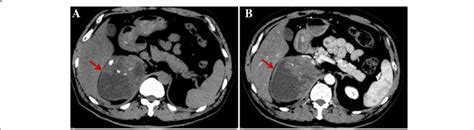 Abdominal Computed Tomography Ct Scan Revealed A Large Mass Arrow