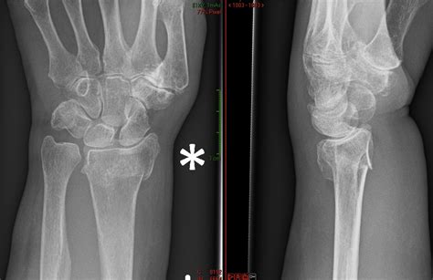 Distal Radial Fracture Aberdeen Virtual Hand Clinic