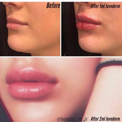 05 Ml Lip Fillers Before And After 1ml