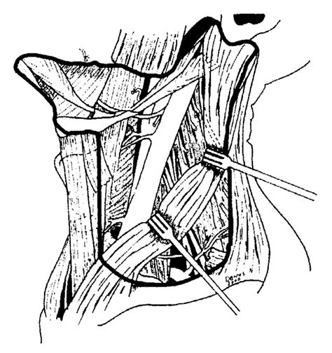 Modified Radical Neck Dissection With Preservation Of The Download