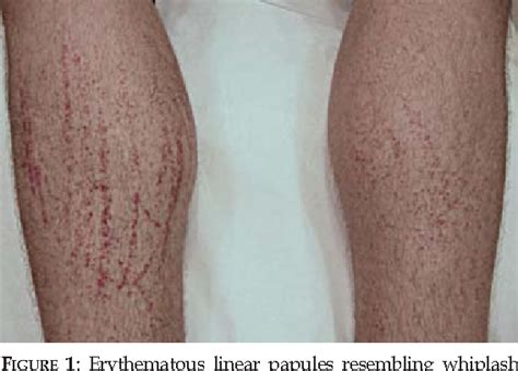 Figure 1 From Shiitake Dermatitis Semantic Scholar