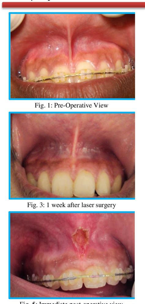 labial frenectomy before and after