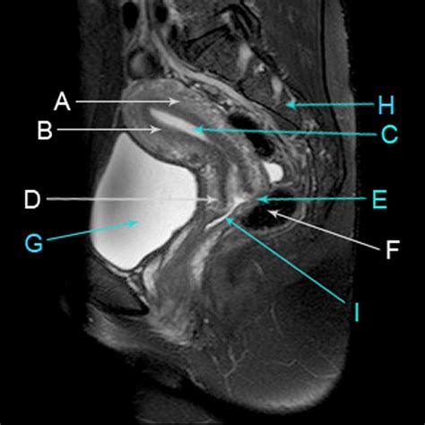 Sagittal T2 Weighted Magnetic Resonance Image Of The Female Pelvis The Bmj