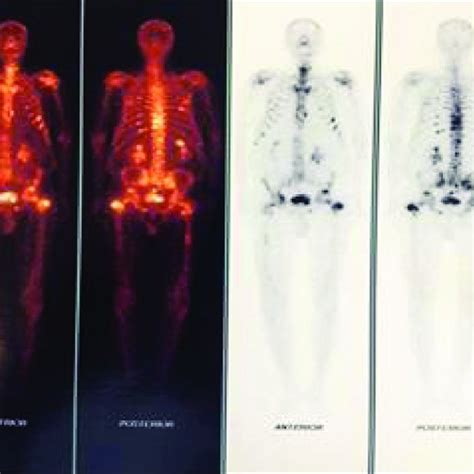 Bone Scintigraphy Tc 99m Mdp 1110 Mbq Showing Multiple Images Of