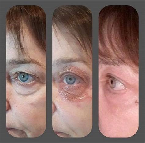 Look At These Amazing Results From Our Fibroblast Plasma Skin