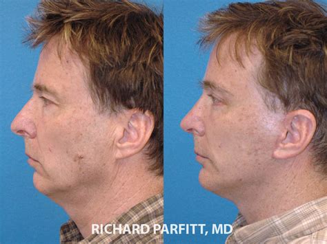 View 3,924 before and after nose surgery photos, submitted by real doctors, to get an idea of the results patients have seen. Male Plastic Surgery Before and After Photos