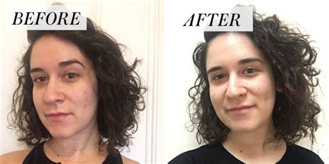 I Stopped Popping My Pimples For A Month Before And After Photos Allure