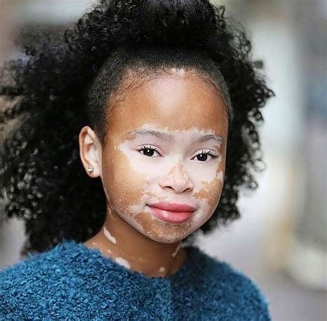 Vitiligo In Babies Images Get More Anythinks