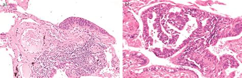 Diffuse Idiopathic Pulmonary Neuroendocrine Cell Hyperplasia Syndrome