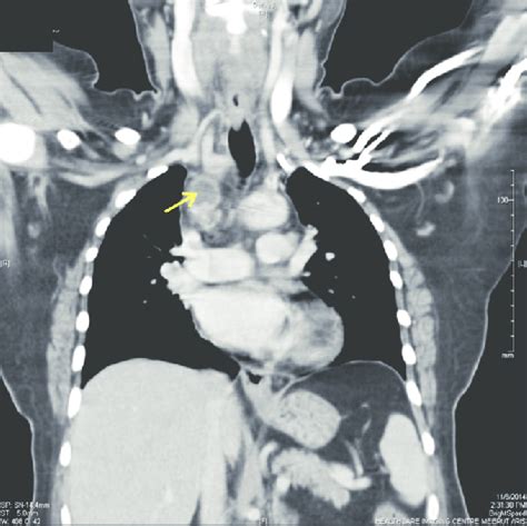 A Follow‑up Case Of Large Retrosternal Thyroid Goiter Who Underwent