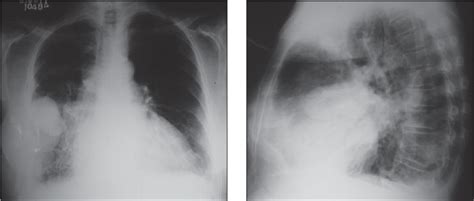 Figure From Phantom Tumor Of The Lung Semantic Scholar