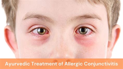 Allergic Conjunctivitis Discharge