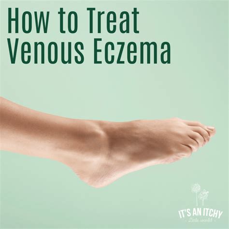 How To Treat Venous Eczema