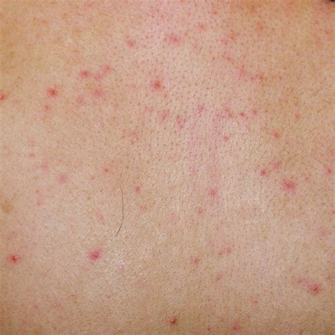 Skin Rashes Caused By Viral Infection Healthy Living Dark Brown Hairs