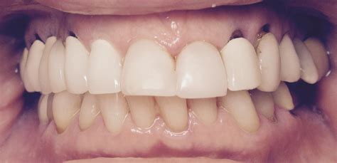 Dental Case Study 38 North Shore Restorative And Implant Dentistry
