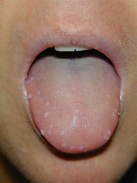 My Experience With Warts Causes Home Treatments And Pictures