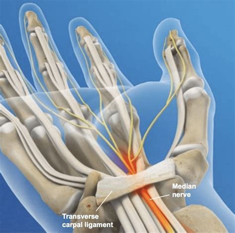 Carpal Tunnel Surgery Recovery Time Info Here Carpal Tunnel Surgeon
