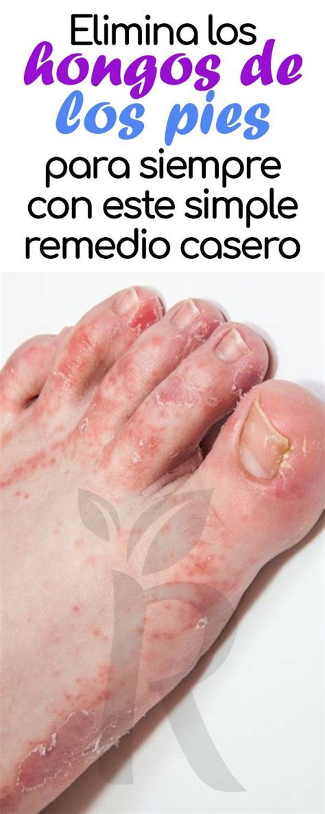 Remedio Casero Para Eliminar Los Hongos De Los Pies Para Siempre Diet