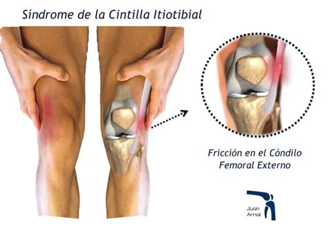 dolor lateral en la rodilla derecha al correr causas y soluciones