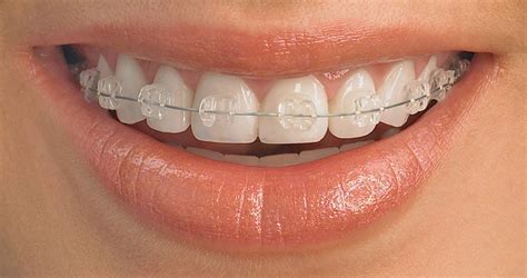 Ceramic Braces Queensgate Dental Practice