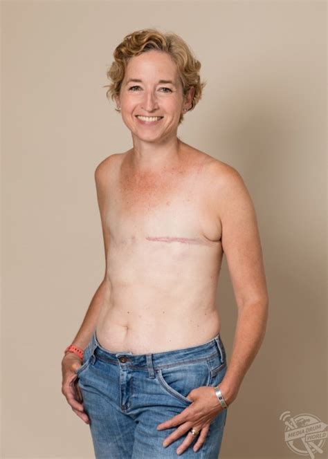 This Courageous Mother Has Posed Topless After Undergoing A Mastectomy