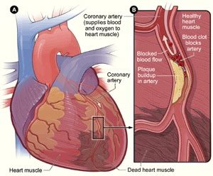 Coronary Artery Disease CAD Cardiac Surgery Michigan Medicine