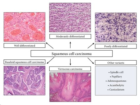 Histologic Subtypes Of Oral Squamous Cell Carcinoma