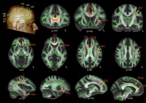 Men With Autism Have Unusual Frontal Lobe Connections In The Brain