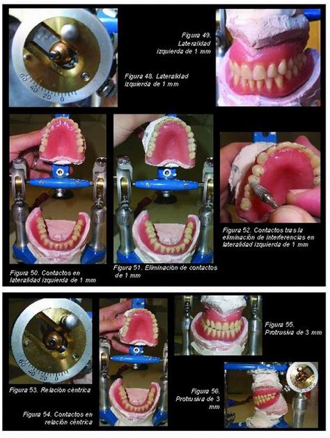 Remontaje Clínico En Prótesis Completa Gaceta Dental