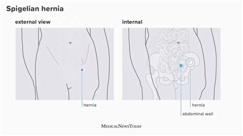 Hernia Pictures A Visual Guide To Different Hernia Types