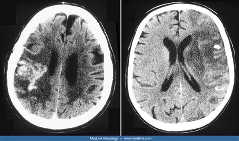 Hemorrhagic Transformation Of Ischemic Stroke Medlink Neurology