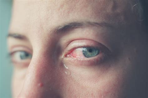 10 Symptoms Of Pink Eye Facty Health