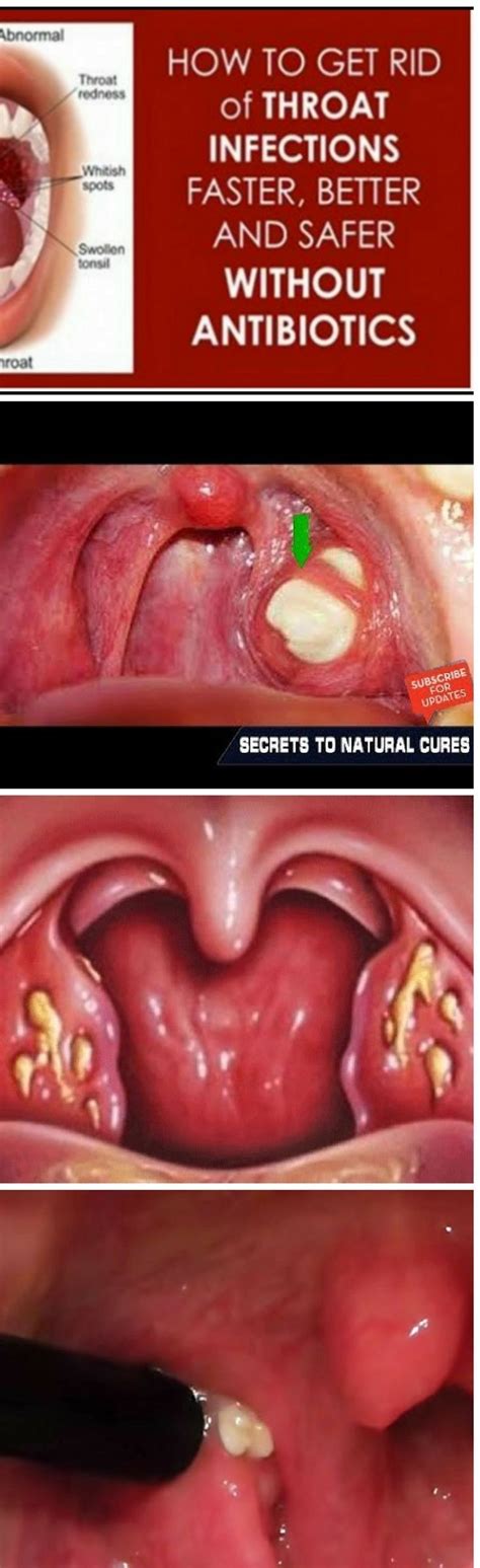 How To Prevent Tonsil Stones Formation How To Do Thing