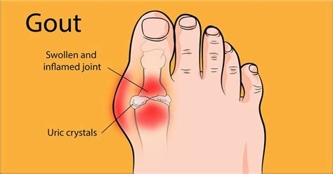 Heres How To Treat Gout At Home And Prevent Another Flare Up From
