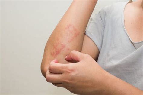 Dermatitis Atópica Una Enfermedad Inflamatoria Frecuente De La Piel