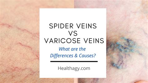 Spider Veins Vs Varicose Veins What Are The Differences And Causes