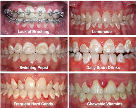 Oral Hygiene Care During Braces Office Of Dr John Digiovanni