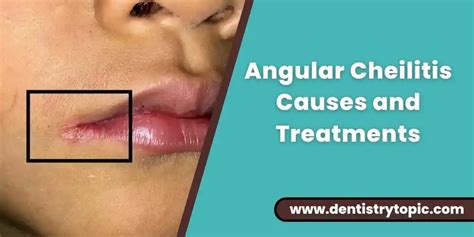 Angular Cheilitis Symptoms Causes Treatments