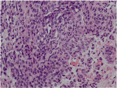 Cystic Metastatic Lymph Nodes In Malignant Melanoma A Case Report