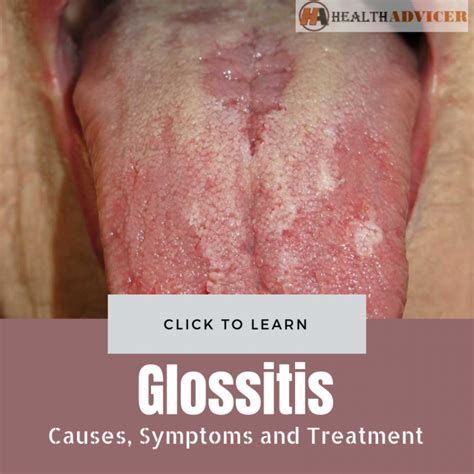 Glossitis Causes Picture Symptoms And Treatment